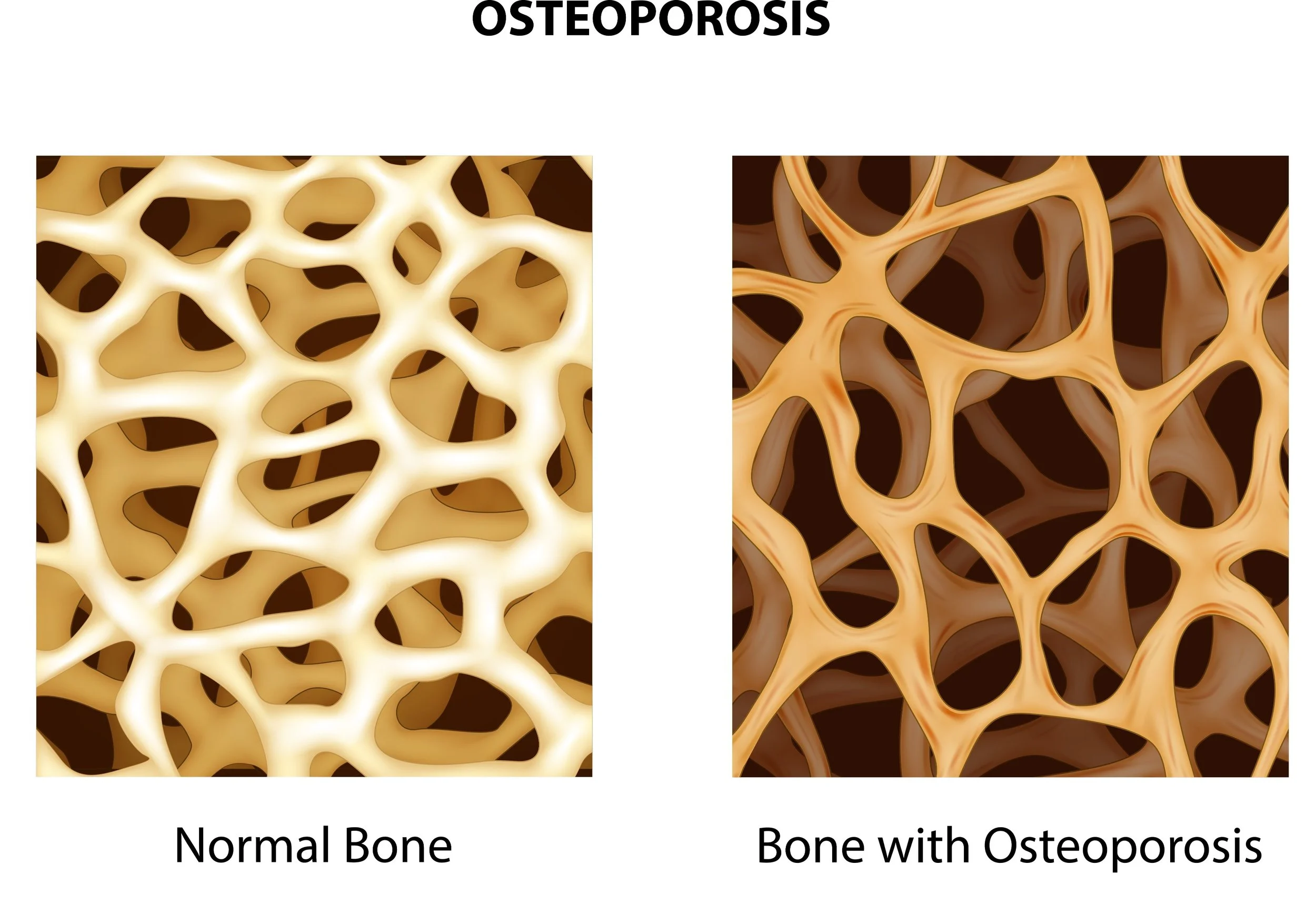 Comparison between normal bone and bone with osteoporosis